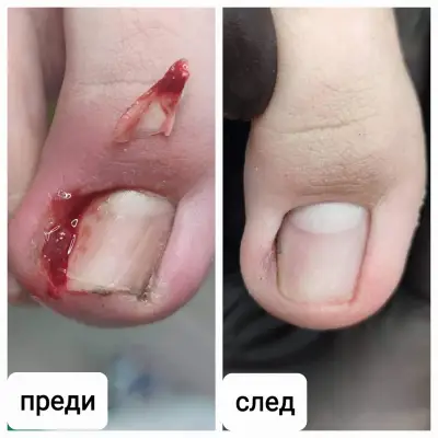 Медицински педикюр в Силистра