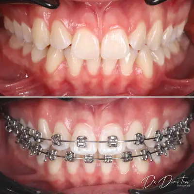 Д-р Димитър Димитров - Ортодонтия | Брекети | Invisalign Алайнери | Пловдив
