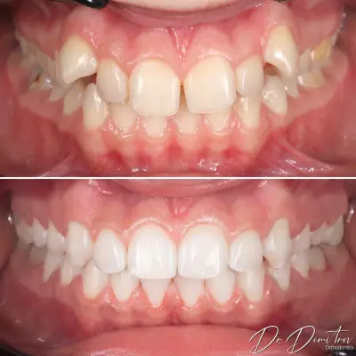 Д-р Димитър Димитров - Ортодонтия | Брекети | Invisalign Алайнери | Пловдив