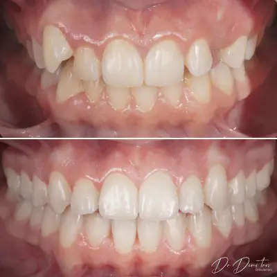 Д-р Димитър Димитров - Ортодонтия | Брекети | Invisalign Алайнери | Пловдив