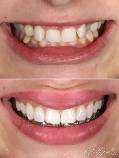 Д-р Димитър Димитров - Ортодонтия | Брекети | Invisalign Алайнери | Пловдив