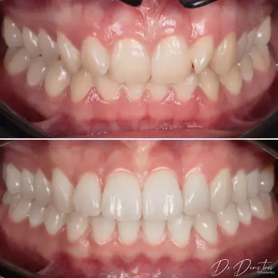 Д-р Димитър Димитров - Ортодонтия | Брекети | Invisalign Алайнери | Пловдив