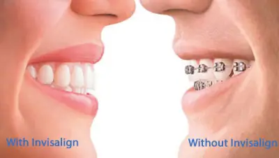 Д-р Ставрева, ортодонтско лечение с алайнери Invisalign