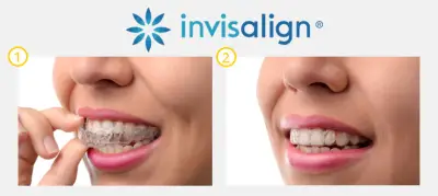 Д-р Ставрева, ортодонтско лечение с алайнери Invisalign