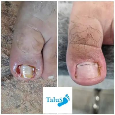 Медицински педикюр-подолог Варна "Talus"
