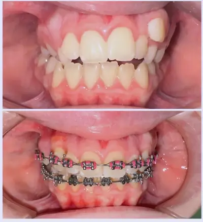 Cross Dent
