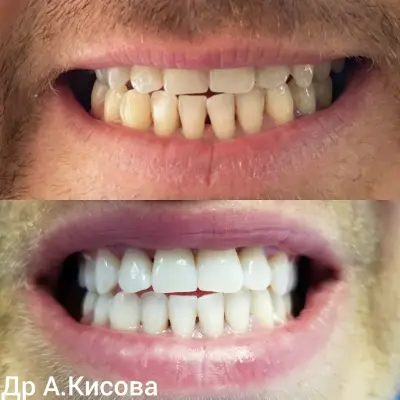Д-Р АНТОАНЕТА КИСОВА - Зъболекар, Лицева естетика