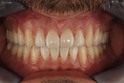 Невидими Брекети - Invisible Braces