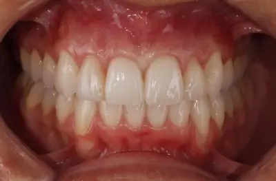 Невидими Брекети - Invisible Braces