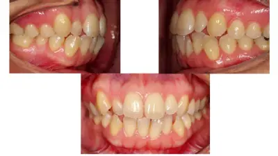 Невидими Брекети - Invisible Braces