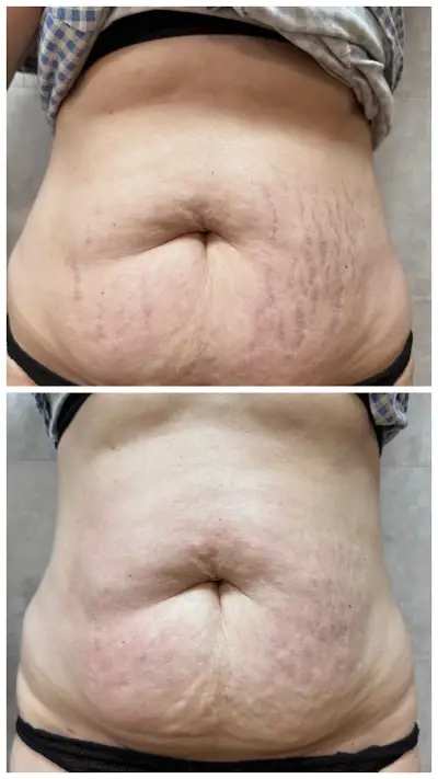 Body correction Varna 2