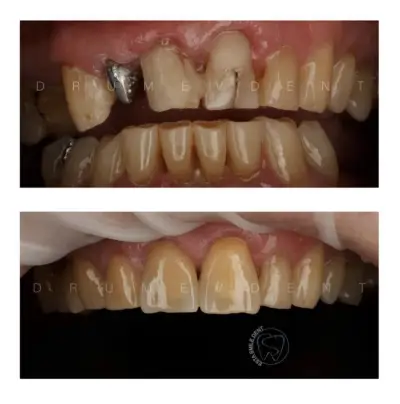 DrumevDent