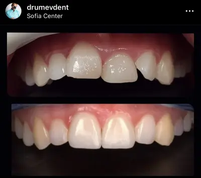 DrumevDent