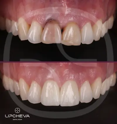 Д-р Ваня Липчева - Пародонтология | Имплантология | Естетика | Dr. Vanya Lipcheva - Periodontology | Implantology |