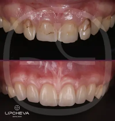Д-р Ваня Липчева - Пародонтология | Имплантология | Естетика | Dr. Vanya Lipcheva - Periodontology | Implantology |