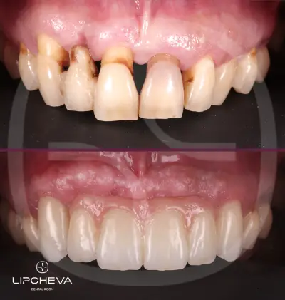 Д-р Ваня Липчева - Пародонтология | Имплантология | Естетика | Dr. Vanya Lipcheva - Periodontology | Implantology |