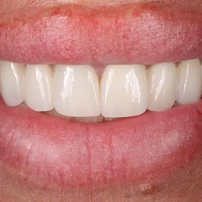 Д-р Ваня Липчева - Пародонтология | Имплантология | Естетика | Dr. Vanya Lipcheva - Periodontology | Implantology |