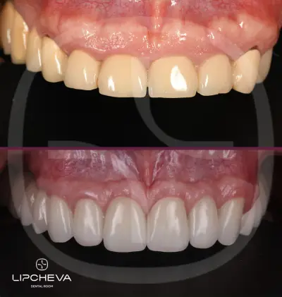 Д-р Ваня Липчева - Пародонтология | Имплантология | Естетика | Dr. Vanya Lipcheva - Periodontology | Implantology |