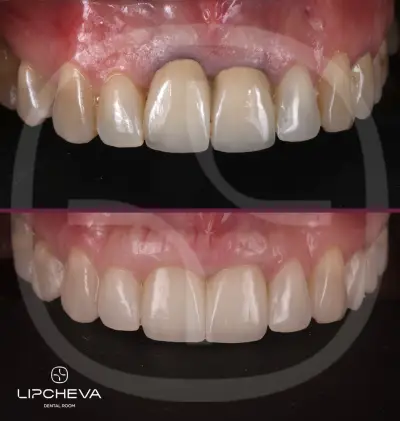 Д-р Ваня Липчева - Пародонтология | Имплантология | Естетика | Dr. Vanya Lipcheva - Periodontology | Implantology |