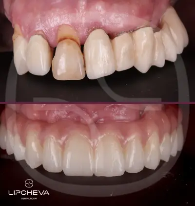 Д-р Ваня Липчева - Пародонтология | Имплантология | Естетика | Dr. Vanya Lipcheva - Periodontology | Implantology |