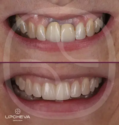 Д-р Ваня Липчева - Пародонтология | Имплантология | Естетика | Dr. Vanya Lipcheva - Periodontology | Implantology |