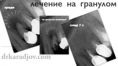 Д-р Светлин Караджов – зъболекар в Бургас, специализиран в ендодонтия под дентален микроскоп
