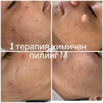 Химичен пилинг